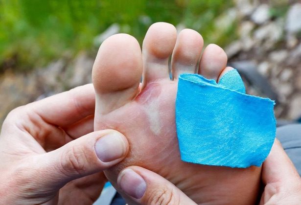 Preventing blisters while hiking